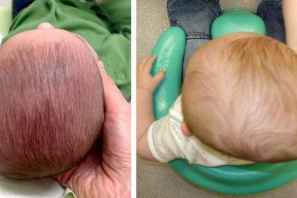 Plagiocefalia: ¿Cómo prevenir y tratar la cada vez más frecuente deformidad de cabeza de los bebés?